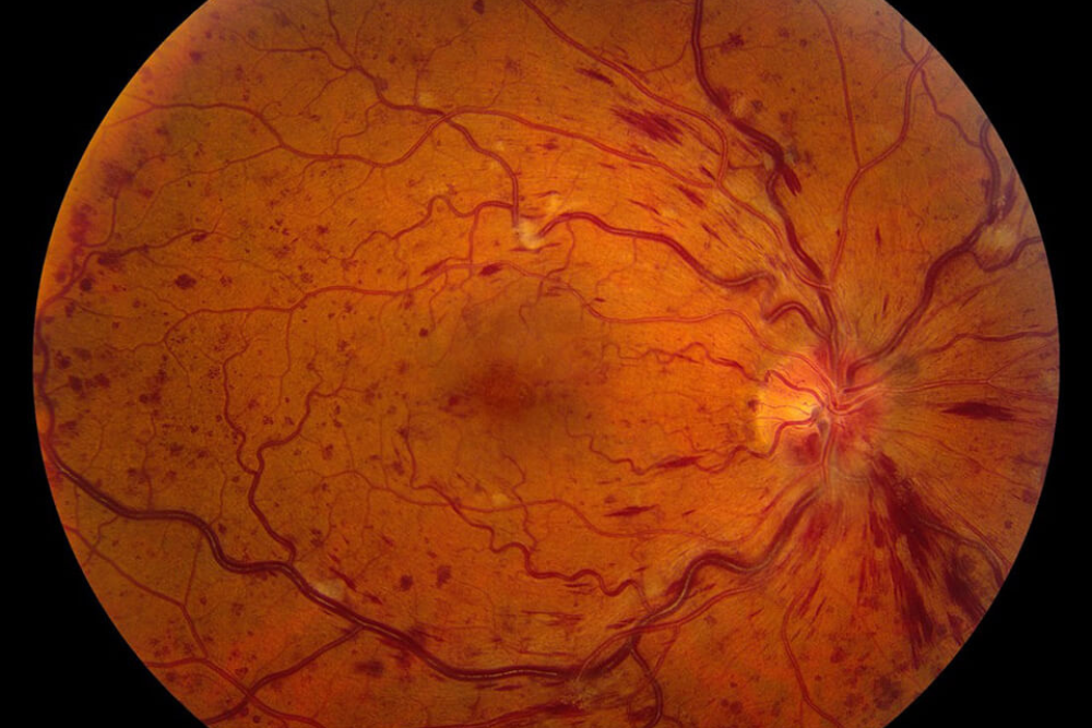 central retinal artery occlusion vs normal