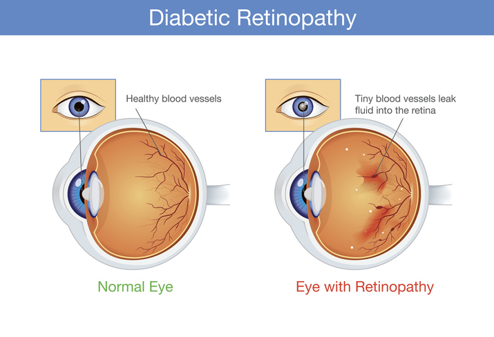Diabetic Retinopathy