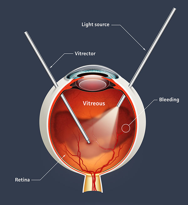 vitreous-separation