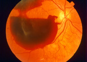 preretinal-hemorrhage